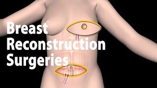 Breast Reconstruction Market Research Reports 2022, Size and In-Depth Qualitative Insights