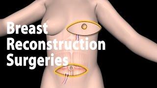 Breast Reconstruction Market